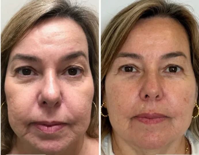 Korean Collagen Lift™ — Mascarilla Rejuvenecedora Coreana